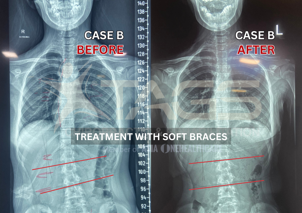 Soft braces for scoliosis before and after