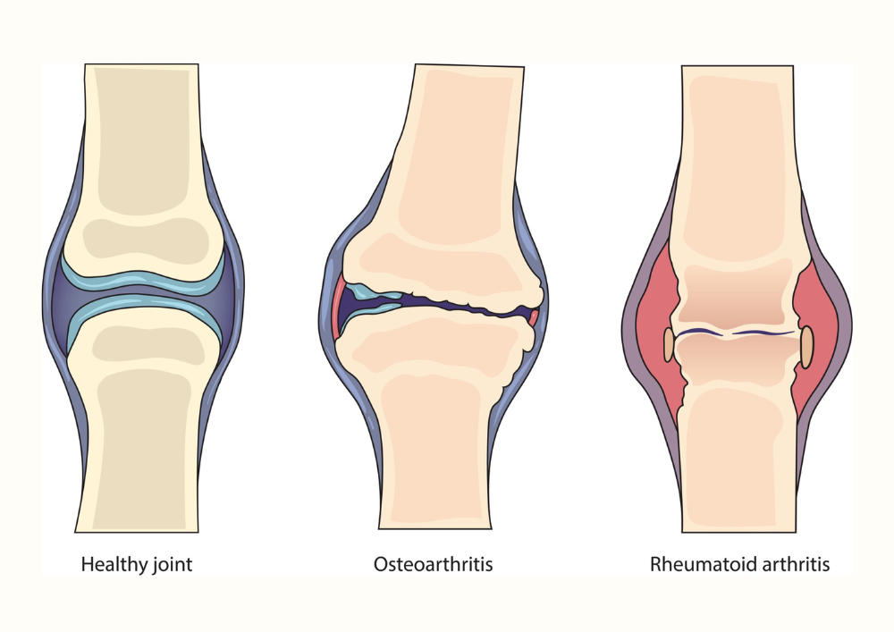 DIFFERENT BETWEEN HEALTH KNEE JOINT, Rheumatoid Arthritis and Osteoarthritis