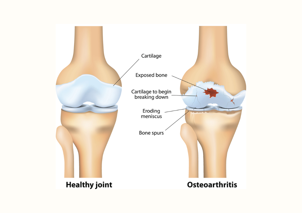 Osteoarthritis