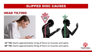 slipped disc - edited Kar Wei 1
