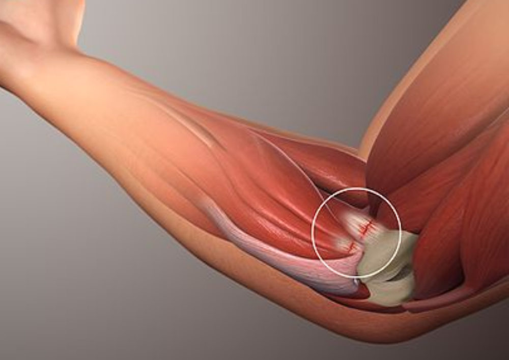 Tendonitis