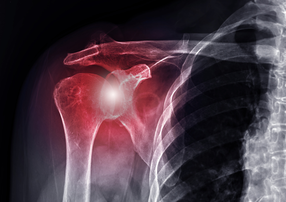 Joint Stiffness