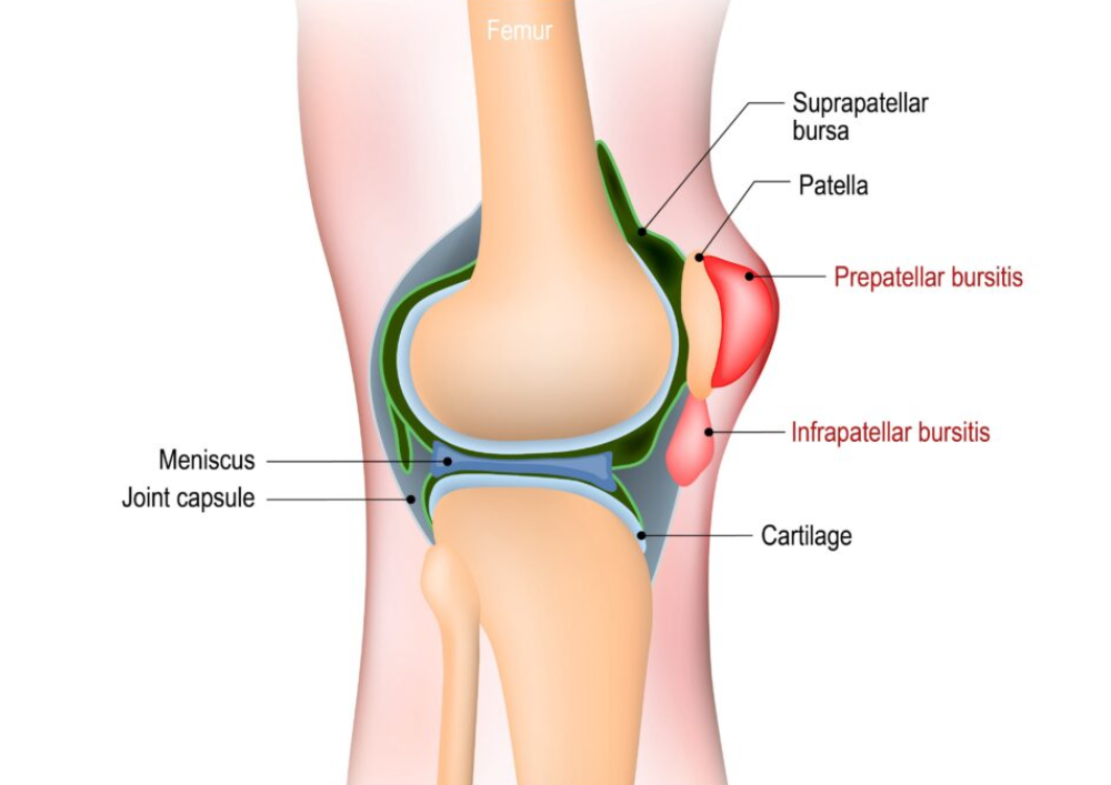 bursitis