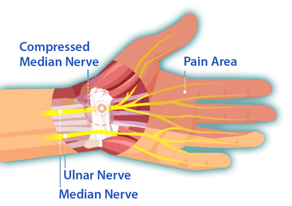 Carpal Tunnel