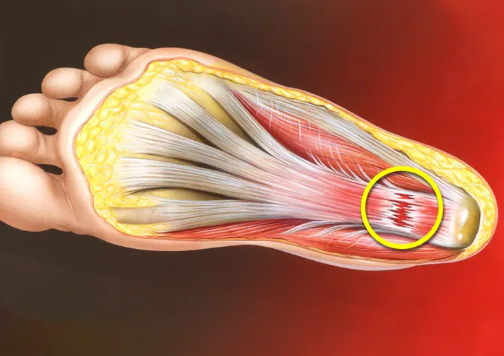 Plantar Fasciitis