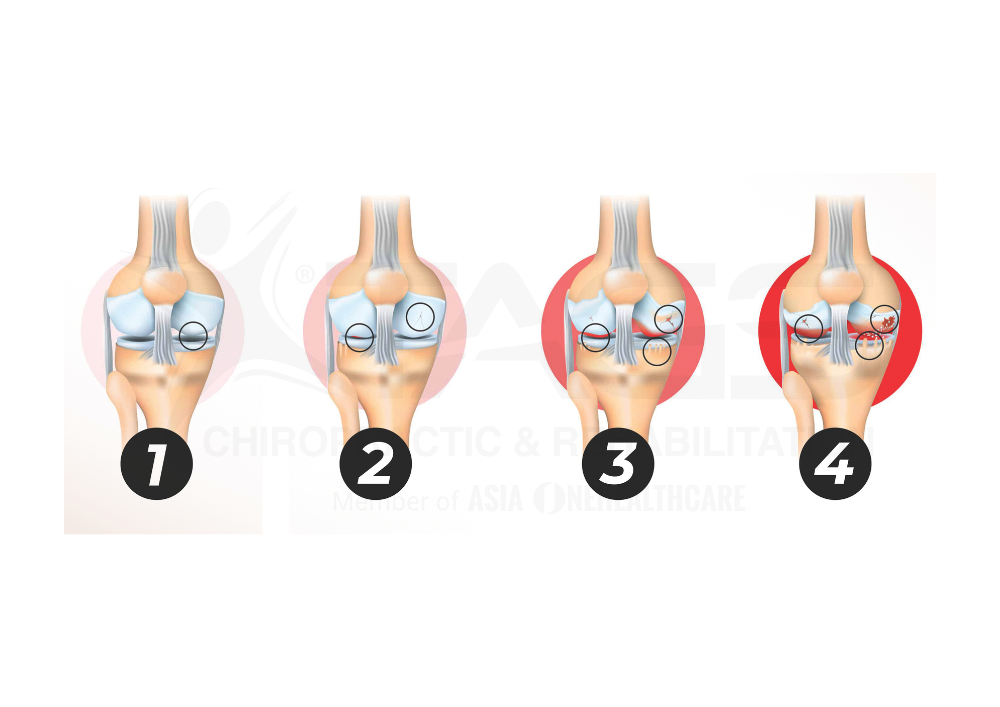 osteoarthritis