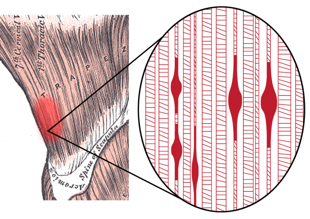 Muscle Knot