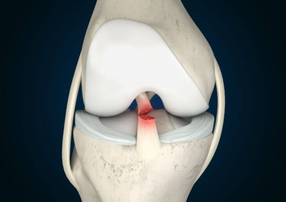 Ligament Tear