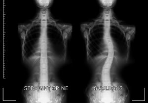 Scoliosis